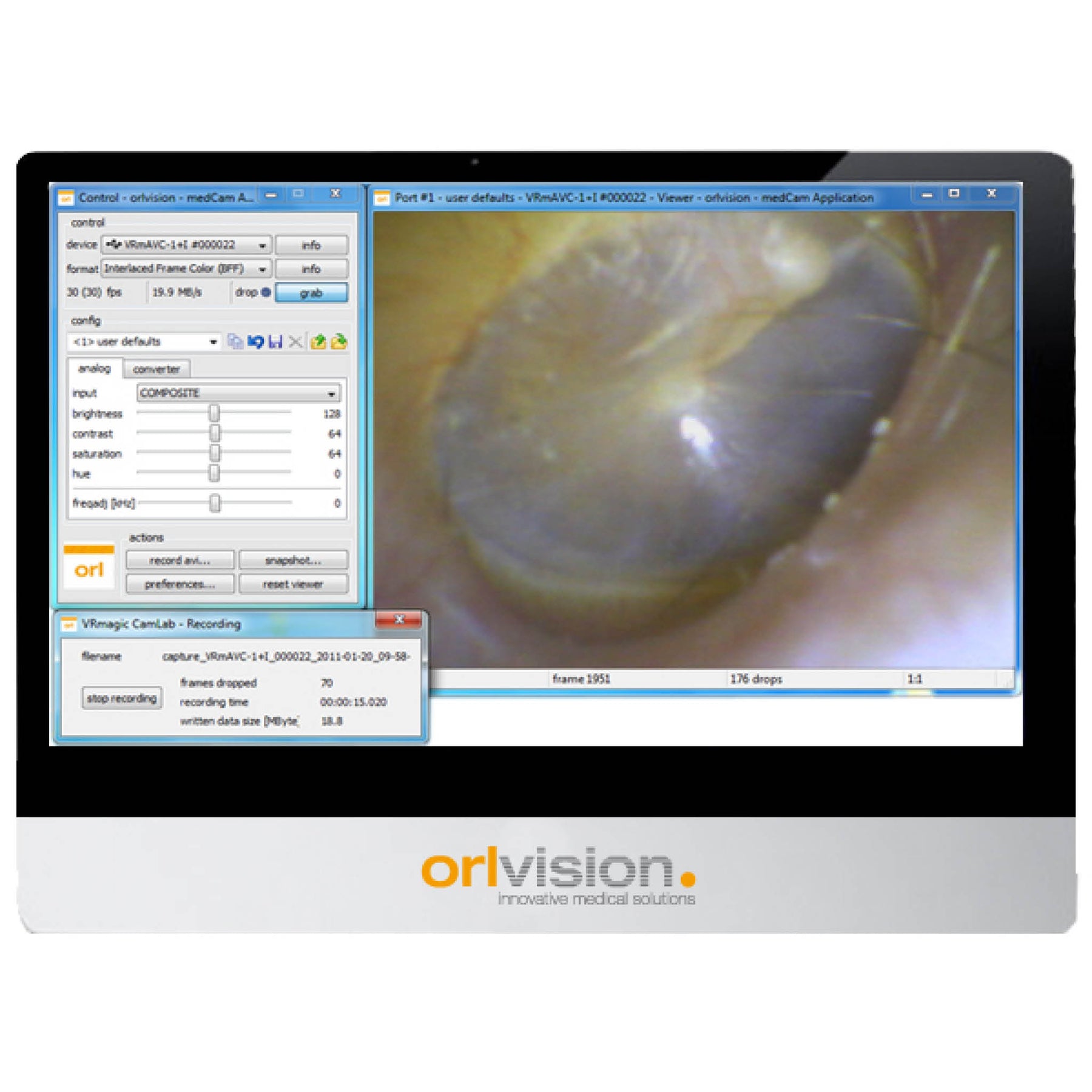 Orlvision Video Otoscope OX2 is optimised for the application areas of the auricle, of the external auditory canal and the eardrum.