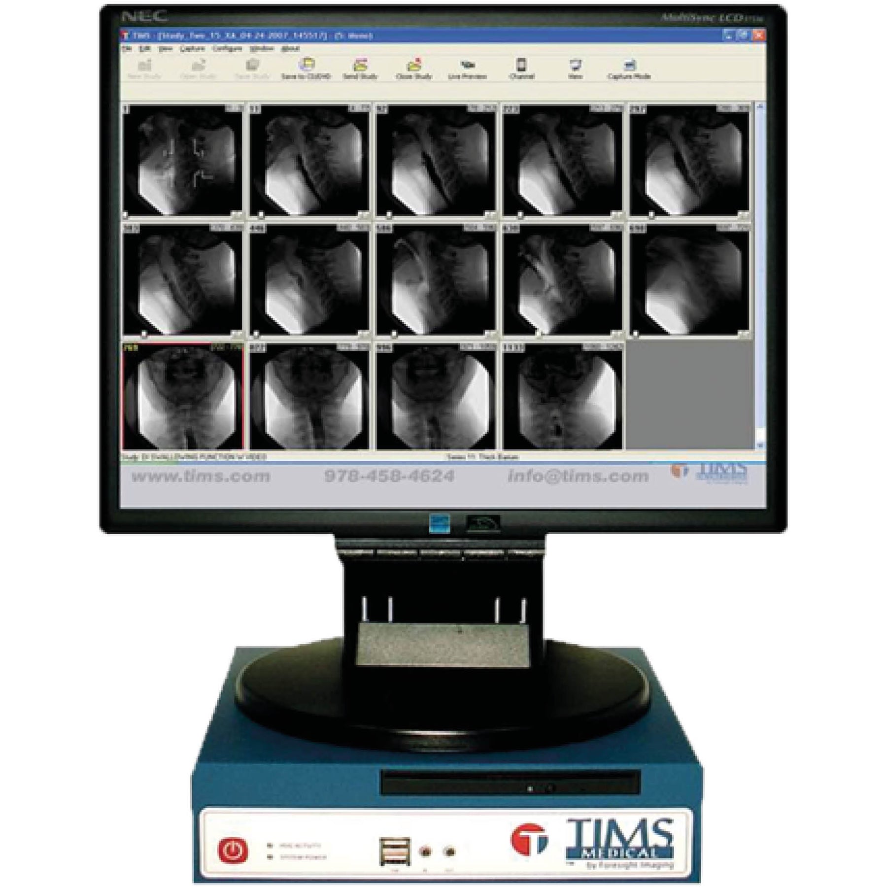 TIMS records the full 1024 x 1024 HD image from the fluoroscopy unit