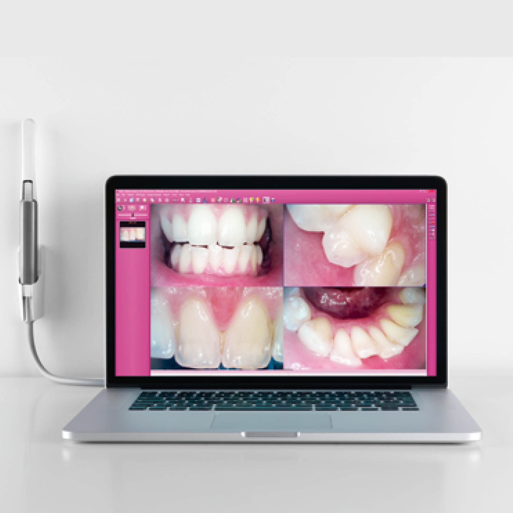 MyRay C-U2 Intraoral Camera with Laptop showing patient mouth and teeth images