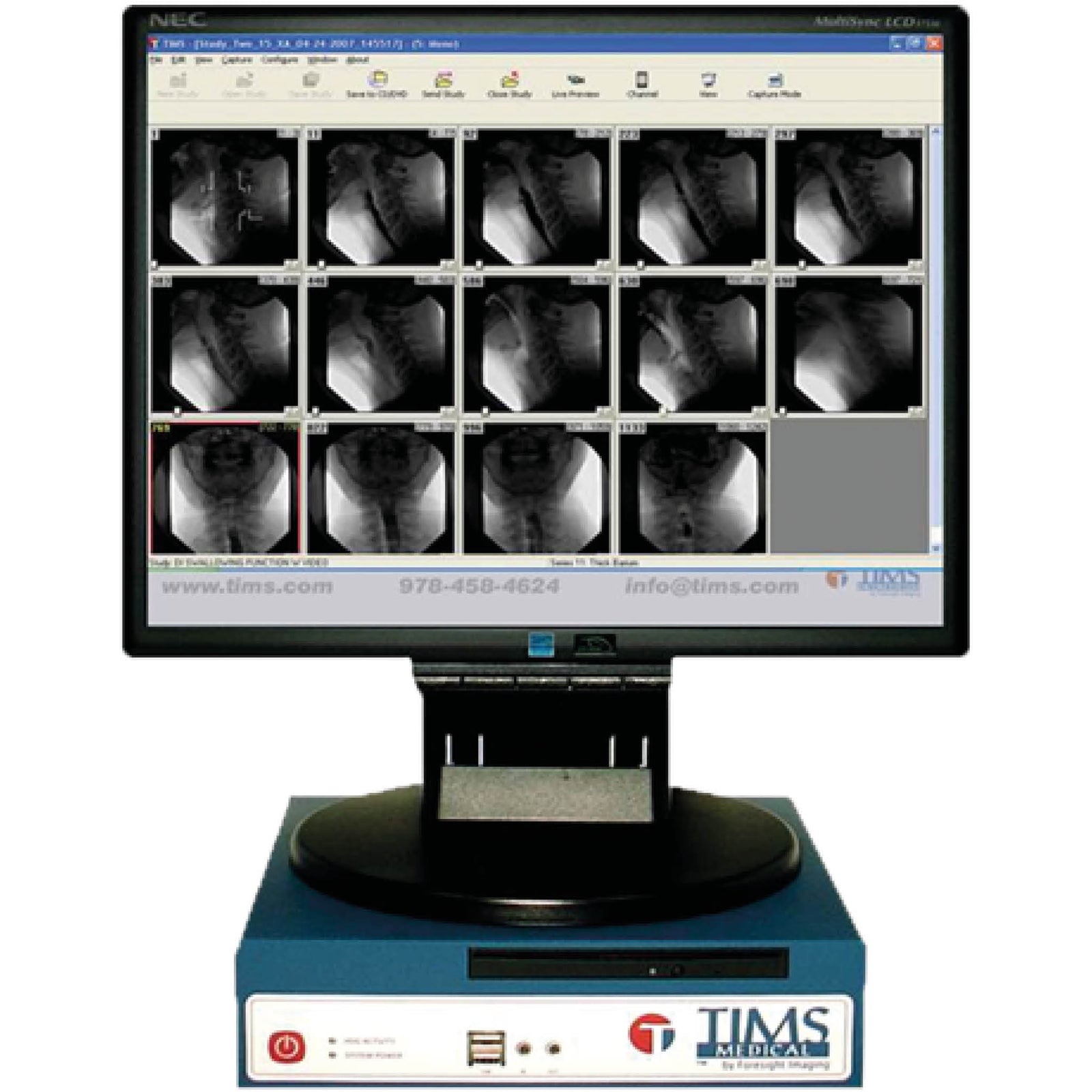 TIMS MVP Diagnostic Imaging Recording & Editing for Swallow Studies